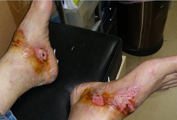 糖尿病人的足部護理與傷口照護原則