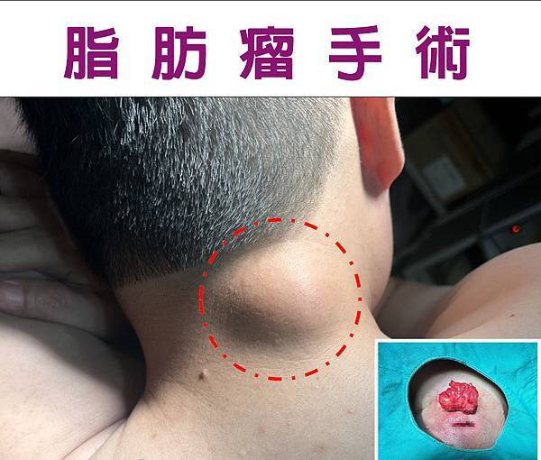 脂肪瘤手術.jpg