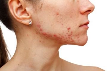 hormonal-acne-treatments-22.jpg