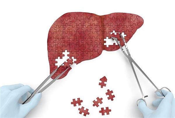 脂肪肝.png 脂肪肝.png