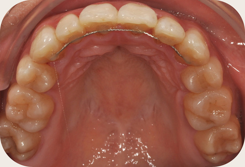 欧唯贝斯和hermione矫正的故事~~我们把牙齿排整齐了