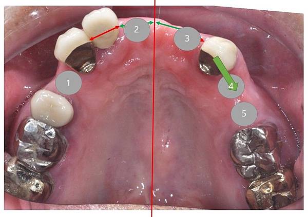 3.1植體位置.jpg