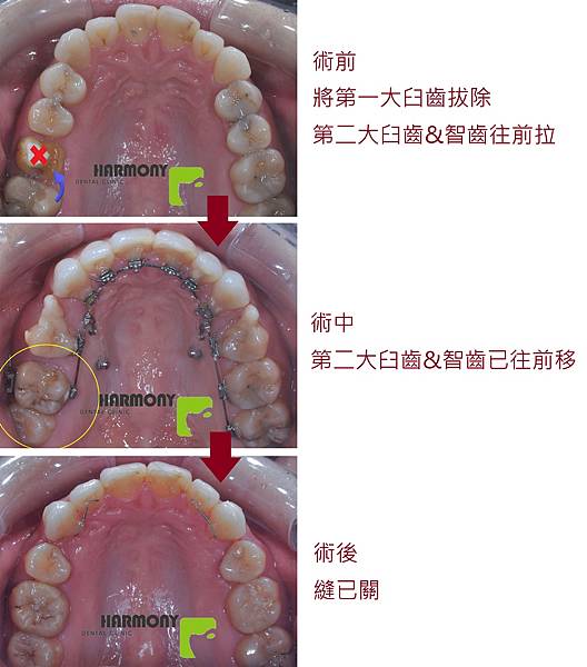 上顎拔牙關縫.1.jpg