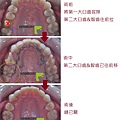 上顎拔牙關縫.1.jpg