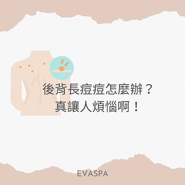 EVASPA燕仔愛漂靚 後背長痘痘怎麼辦？