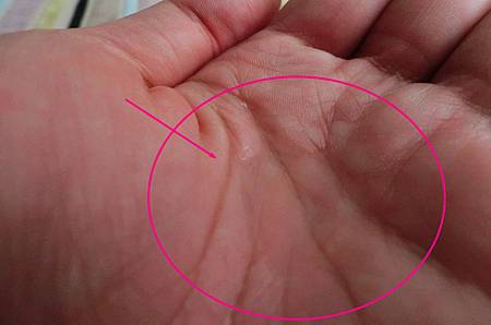 粉刺代謝噴霧 粉刺代謝噴霧