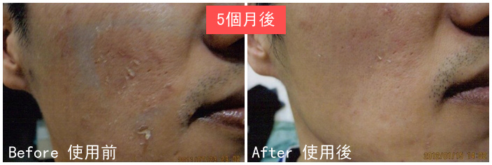 F先生使用前後比對圖.jpg F先生使用前後比對圖.jpg