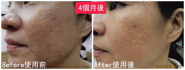H小姐使用前後比對圖.jpg H小姐使用前後比對圖.jpg