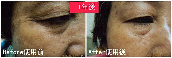 Y女士使用前後比對圖.jpg Y女士使用前後比對圖.jpg