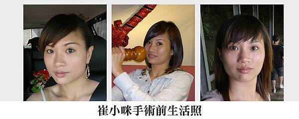 顴骨削骨手術下顎骨角削骨手術隆鼻抽脂隆乳墊下巴術前 顴骨削骨手術下顎骨角削骨手術隆鼻抽脂隆乳墊下巴術前