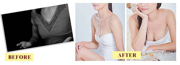 011自體脂肪隆乳豐胸手術台北台中高雄.jpg 011自體脂肪隆乳豐胸手術台北台中高雄.jpg