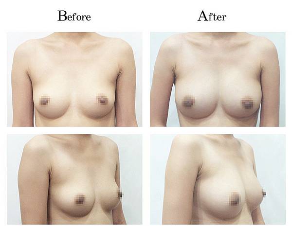 崔小咪自體脂肪隆乳 崔小咪自體脂肪隆乳