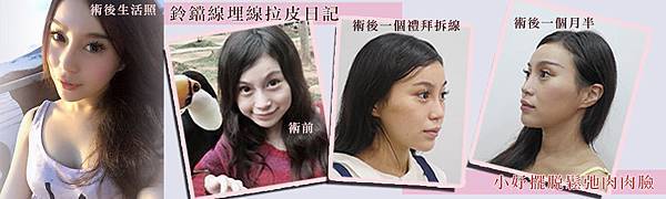 01埋線拉提拉皮手術費用價格價錢價位.jpg 01埋線拉提拉皮手術費用價格價錢價位.jpg