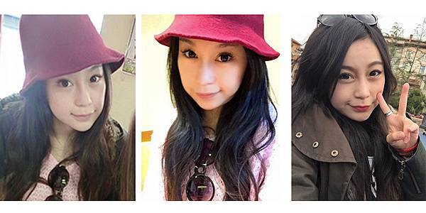 02埋線拉提拉皮手術失敗後遺症風險效果.jpg 02埋線拉提拉皮手術失敗後遺症風險效果.jpg