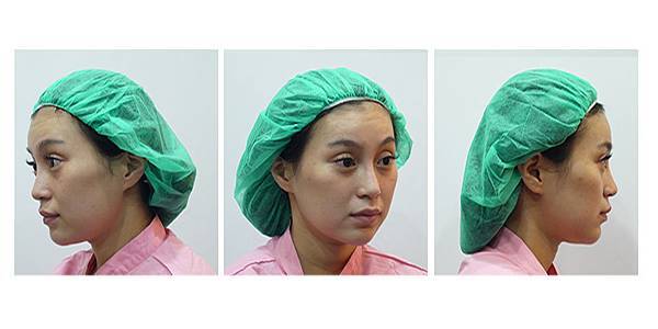 03埋線拉提拉皮手術PTT權威醫師醫生推薦.jpg 03埋線拉提拉皮手術PTT權威醫師醫生推薦.jpg