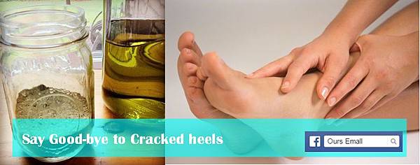 Say good-bye to cracked heels