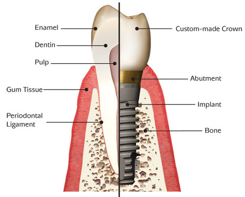 implant_anatomy-basic-pic