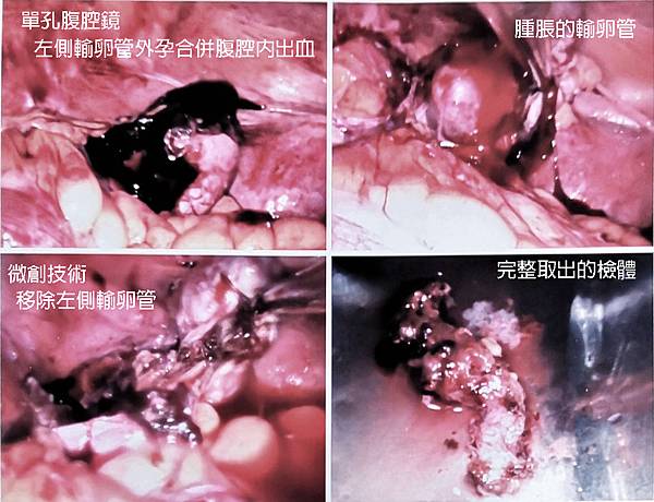 2018-11-29 單孔腹腔鏡02.jpg