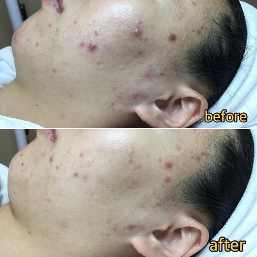 赫本女孩：肌膚改變的魔法，讓您告別困擾！>>台北板橋做臉台北