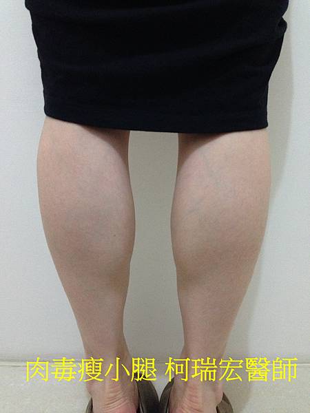 肉毒瘦小腿 (纖纖玉腿術)