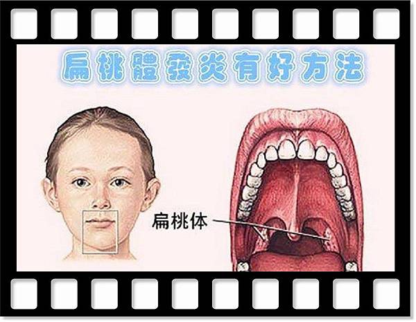 扁桃體發炎有好方法