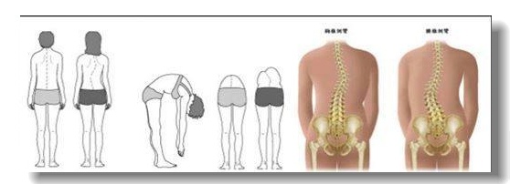 脊椎側彎的治療方法
