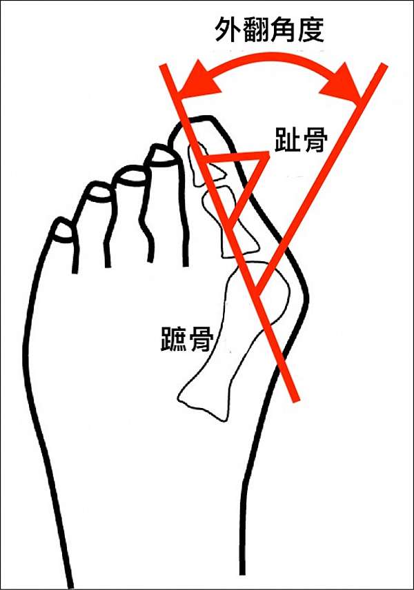 讀完 拇趾外翻一族 全都獲得救贖 慈民骨科bone Joy 痞客邦