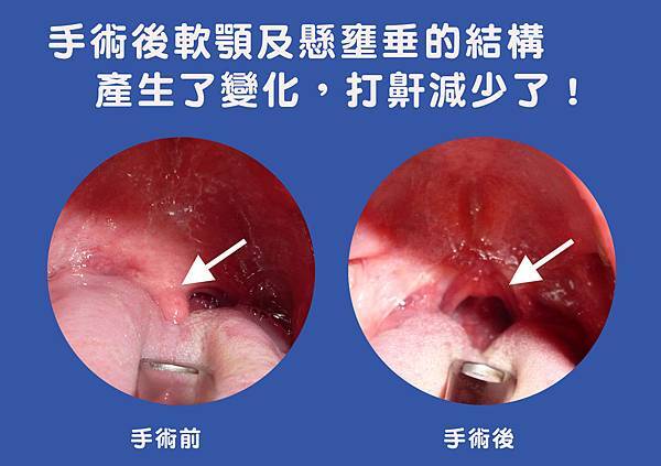 術後對照圖