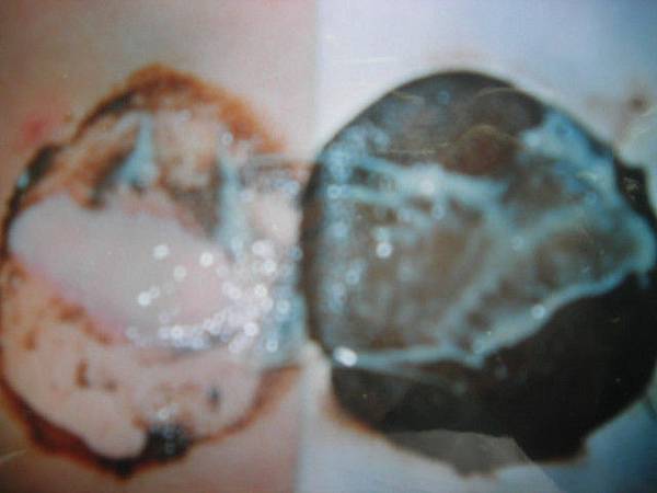 拔膿術二十四小時後出『膿』的情形( 第二天 ).