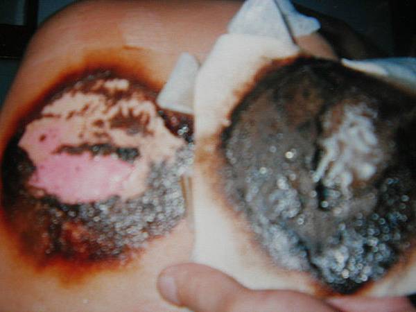 這種情況下,洗澡後才換藥,一天換一次即可. 這種情況下,洗澡後才換藥,一天換一次即可.