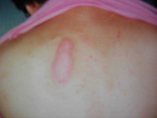 皮膚已癒合,抹上植物油,外面用紗布覆蓋,膠帶固定( 治療膏肓酸痛 ). 皮膚已癒合,抹上植物油,外面用紗布覆蓋,膠帶固定( 治療膏肓酸痛 ).