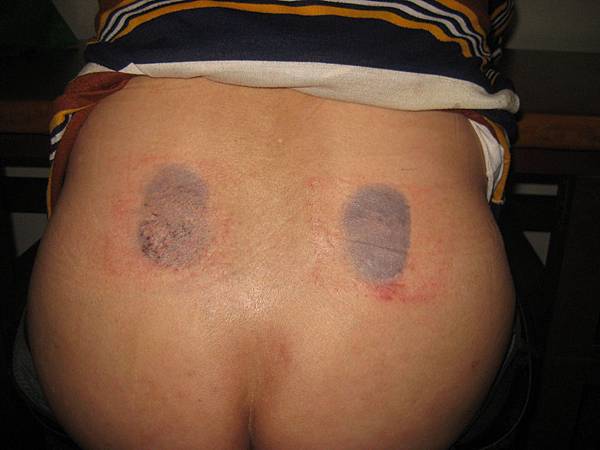 坐骨神經痛（椎間盤突出）的另類療法