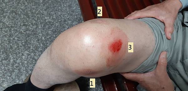 案例二十三:膝關節炎兼積水 案例二十三:膝關節炎兼積水