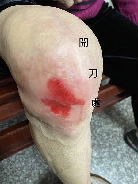 退化性關節炎開刀無效