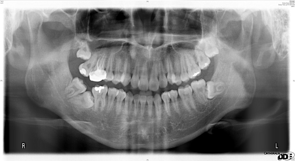 [問題] 第二大臼齒長歪 矯正或植牙