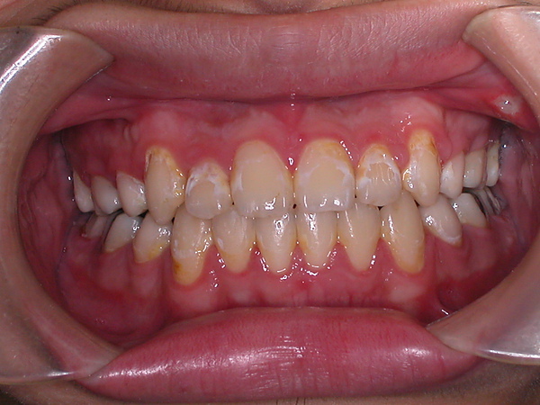 矫正期间因为口腔卫生不佳造成的牙齿脱钙