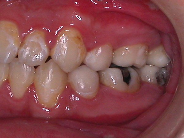 矫正期间因为口腔卫生不佳造成的牙齿脱钙