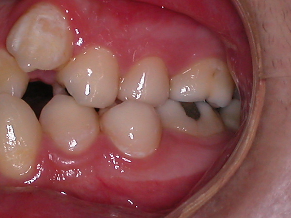 矫正期间因为口腔卫生不佳造成的牙齿脱钙