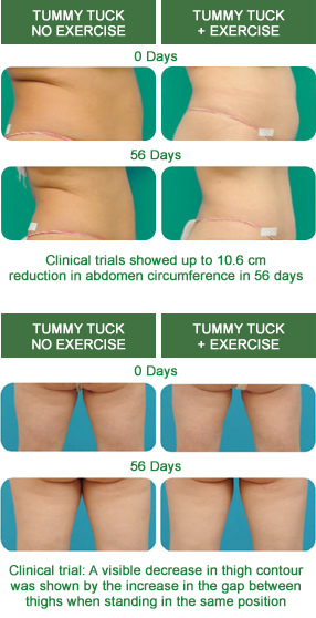 tummytuck-before-after (1).jpg