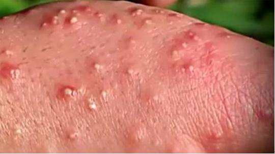 火蟻咬傷.jpg 火蟻咬傷.jpg