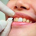 隱形美齒貼片-完美牙醫1.jpg