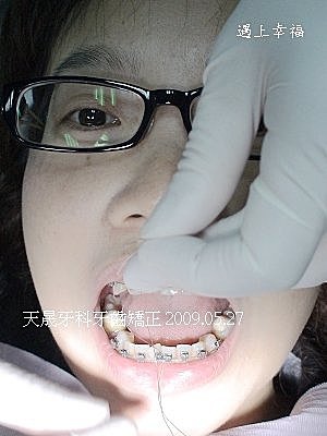 6牙齒矯正天晟牙科.jpg