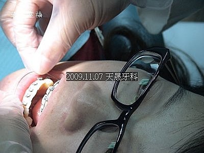 07 2009.11.07牙齒矯正.jpg