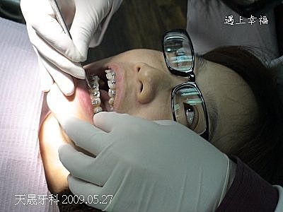 1牙齒矯正天晟牙科5-27.jpg