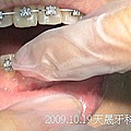 09 2009.10.19天晟牙科 牙齒矯正.j