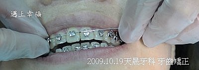05 2009.10.19天晟牙科 牙齒矯正.j