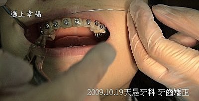 03 2009.10.19天晟牙科 牙齒矯正.j