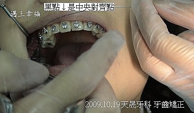 04 2009.10.19天晟牙科 牙齒矯正.j