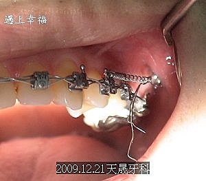 05牙齒矯正 骨釘彈簧.jpg