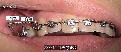 04牙齒矯正 骨釘彈簧.jpg